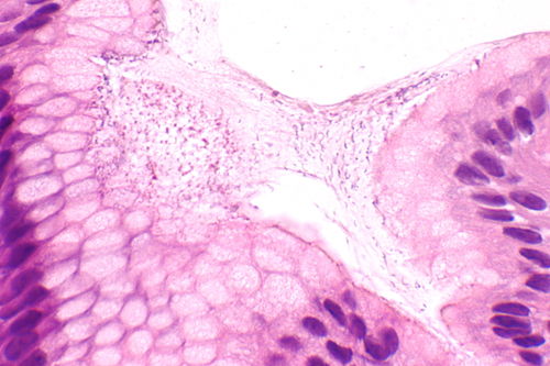 Helicobacter gastritis -- extremely high mag.jpg
