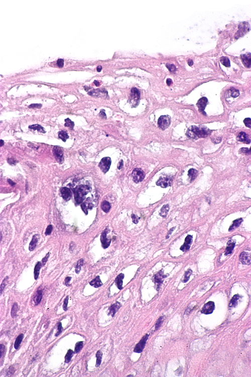 Low-grade squamous intraepithelial lesion -- very high mag.jpg