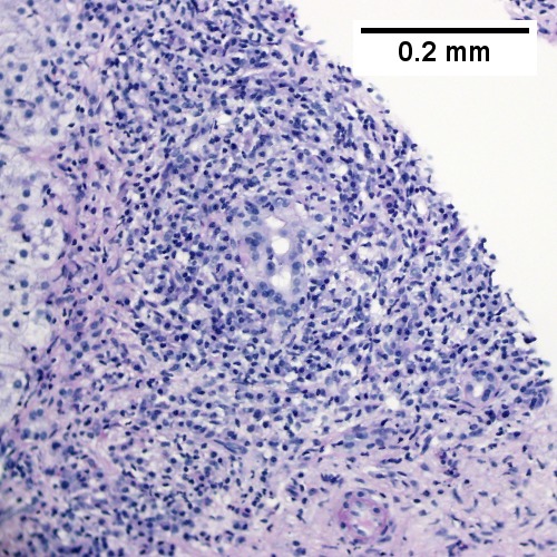 PAS with diastase shows intense inflammation of portal triad stroma, with some reduplication of ductal epithelium. The patient’s vial serology and anti-microbial antibody were negative. (200X).