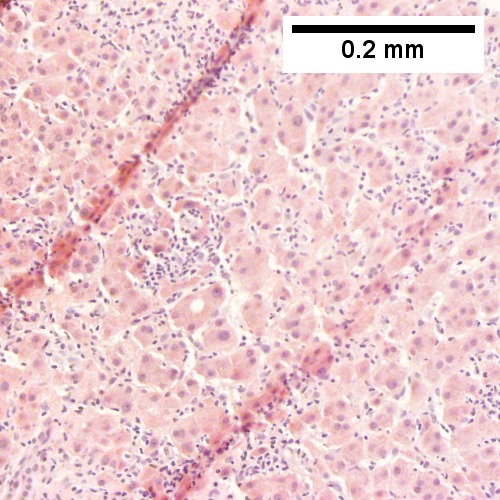 File:5 B cell lym liver 1 680x512px.tif
