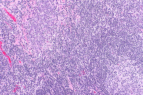 Squamous cell carcinoma - p16 positive -- intermed mag.jpg