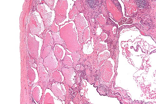 Pulmonary alveolar proteinosis -3- low mag.jpg