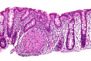 Crohn's disease - Libre Pathology