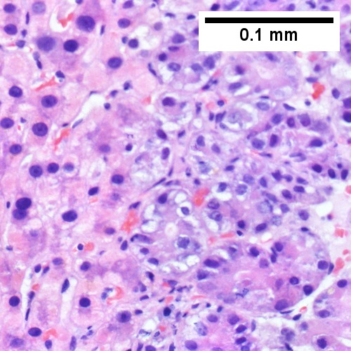 Noncancerous hepatocytes on left can be compared with tumor cells on right. Note increased nuclear crowding & a subtle increment in cytoplasmic basophilia in tumor (Row 2 Right 400X).
