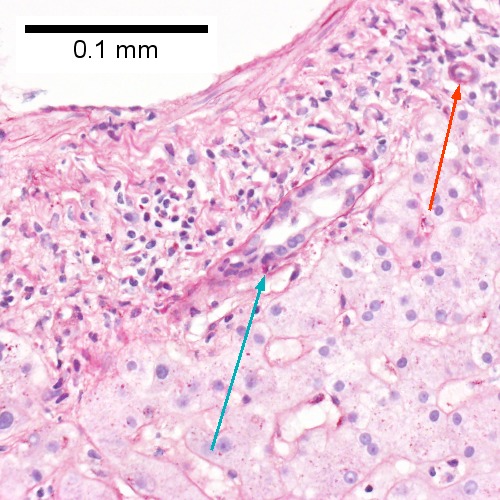 A PAS with diastase stain colors the arteriole (red arrow), as well as the rim of the interlobular duct within which lies a neutrophil (cyan arrow) (Row 1 Right 400X)