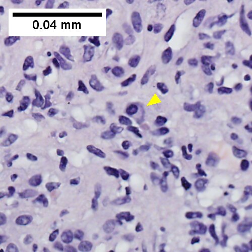 Inflammation includes occasional plasma cells (yellow arrowhead)