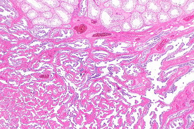 Adenomatous hyperplasia of the rete testis -- very low mag.jpg