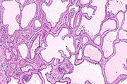 Tubulocystic carcinoma of the kidney - Libre Pathology