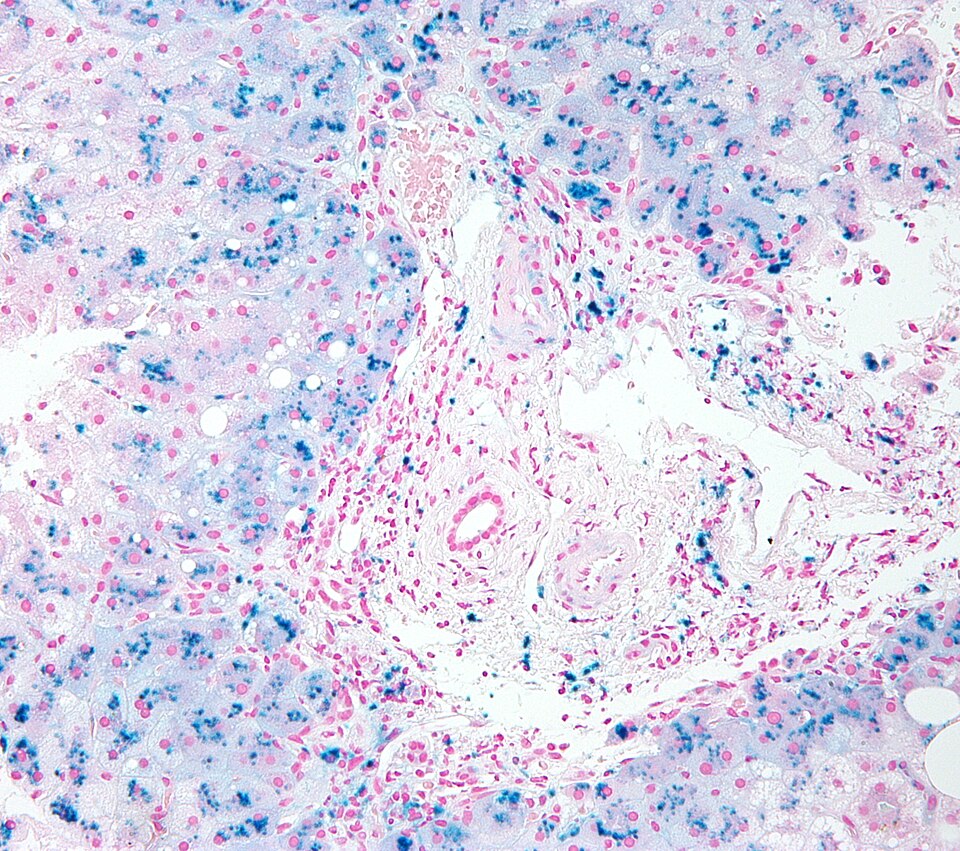 File:Hemosiderosis high mag.jpg