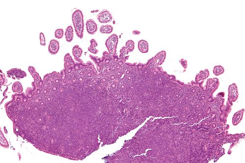 Mantle cell lymphoma - low mag.jpg