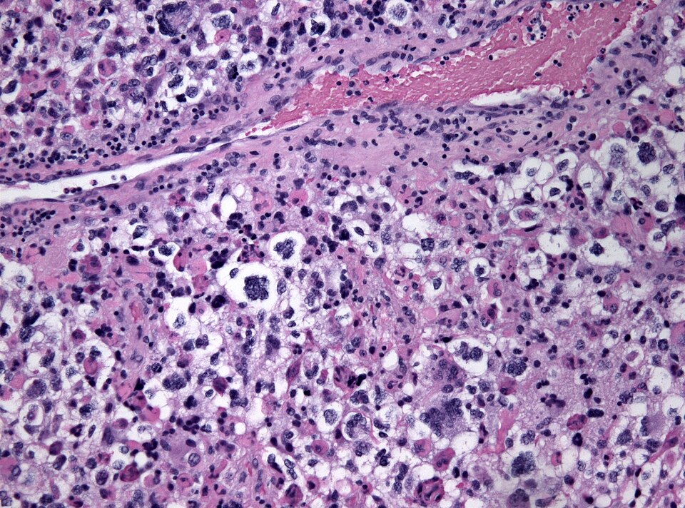 File:Anaplastic pxa histology.jpg