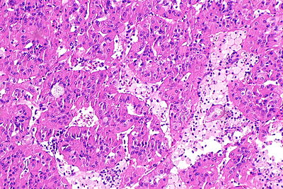 Eosinophilic, solid and cystic renal cell carcinoma - histiocytes -- intermed mag.jpg