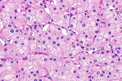 Eosinophilic variant of chromophobe renal cell carcinoma -- high mag.jpg