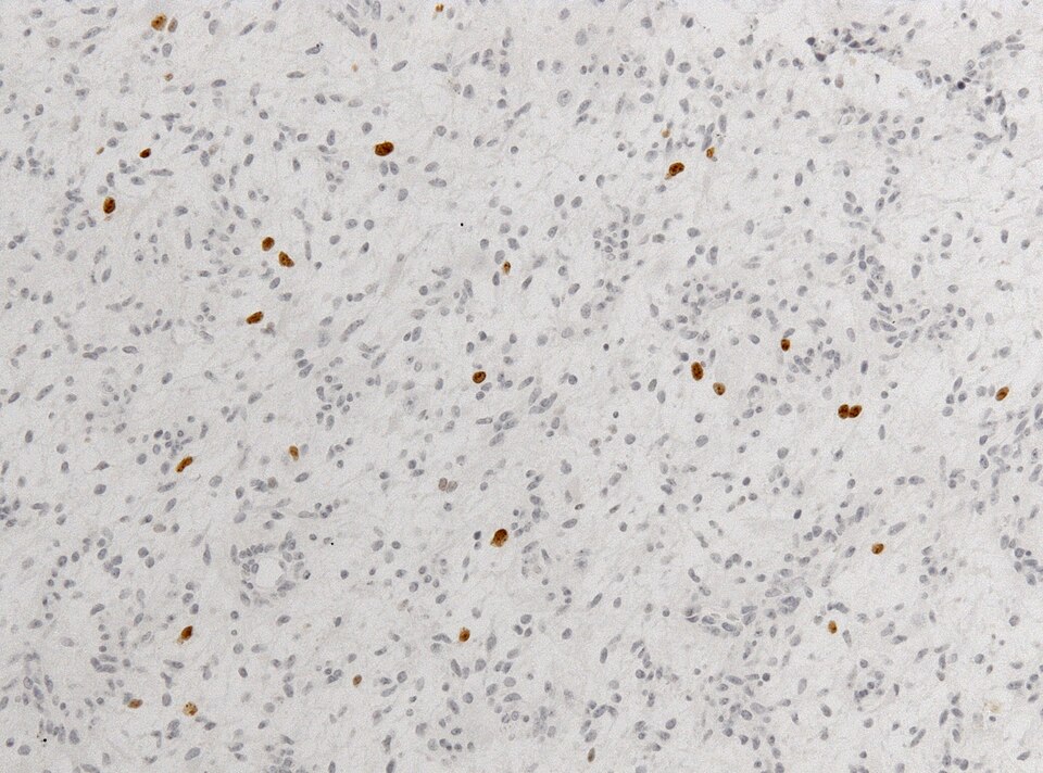 File:Neuropathology case V 07.jpg