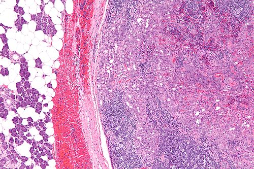 Acinic cell carcinoma - intermed mag.jpg