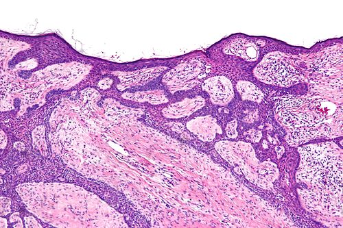 Basal cell carcinoma fibroepitheliomatous pattern - intermed mag.jpg