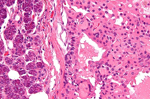 Parotid gland oncocytoma - very high mag.jpg