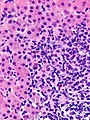 Autoimmune hepatitis - cropped - very high mag.jpg