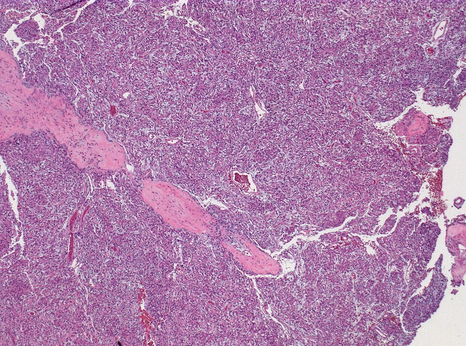 File:Neuropathology case XI 01.jpg