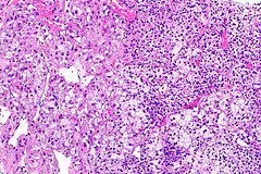 TFEB-rearranged renal cell carcinoma - Libre Pathology