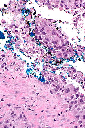 Cancer de pancreas en jovenes - Bladder papilloma libre pathology