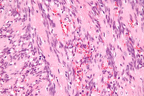 Intranodal palisaded myofibroblastoma - very high mag.jpg