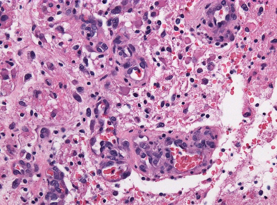 File:Neuropathology case IX 03.jpg