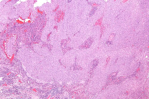 Glassy cell carcinoma - low mag.jpg