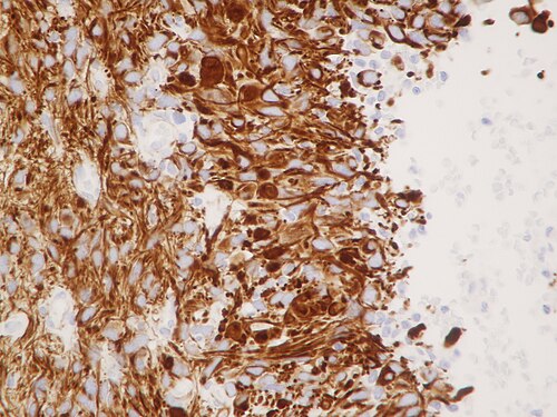 Wilms tumor protein wt1 immunohistocehmistry glioblastoma.JPG