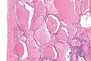 pulmonary edema histology macrophages