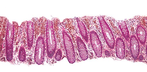 Melanosis coli low mag.jpg
