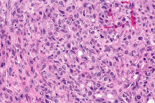 Carcinoma ex pleomorphic adenoma -- high mag.jpg