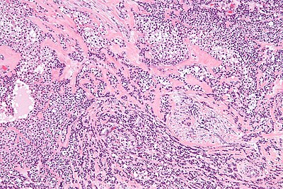 Hyalinizing clear cell carcinoma - intermed mag.jpg