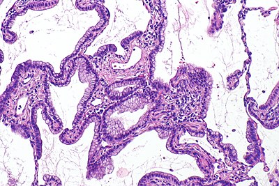 Mucinous lung adenocarcinoma -- intermed mag.jpg