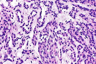 Renal mucinous tubular and spindle cell carcinoma -- high mag.jpg