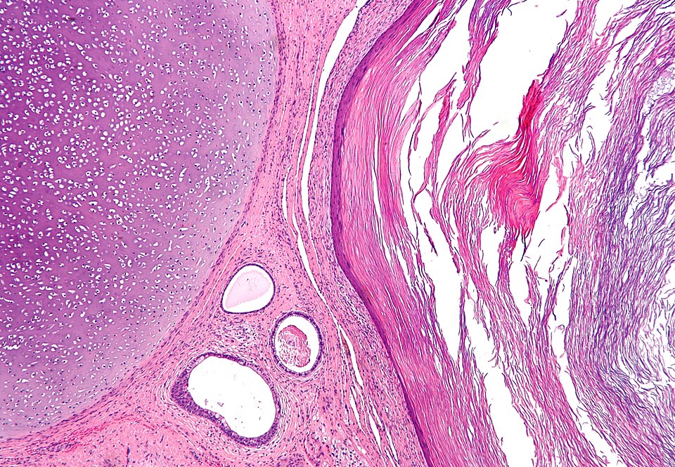 File:Teratoma 2 low mag.jpg