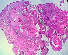 Keratoacanthoma - Libre Pathology