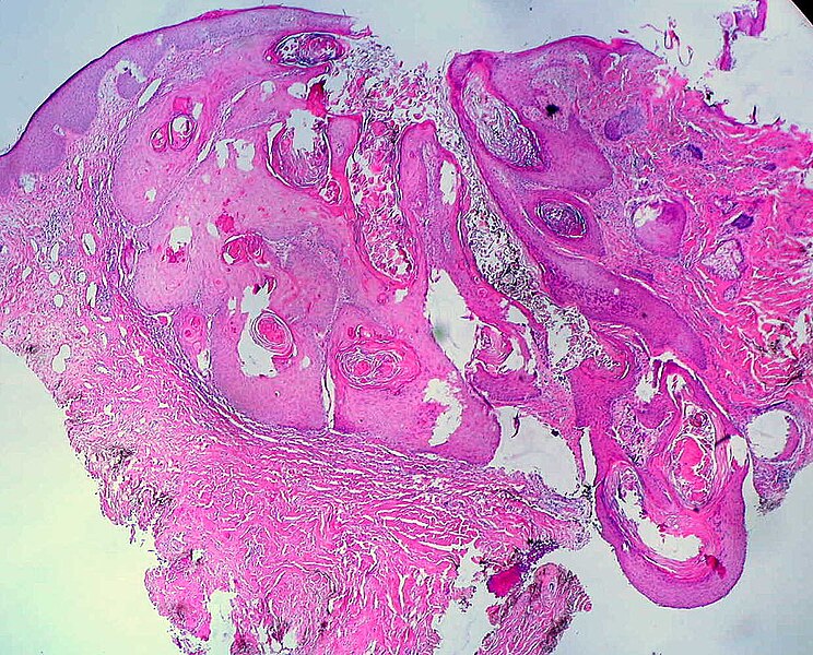 FileKeratoacanthoma (2), H&E.jpg Libre Pathology
