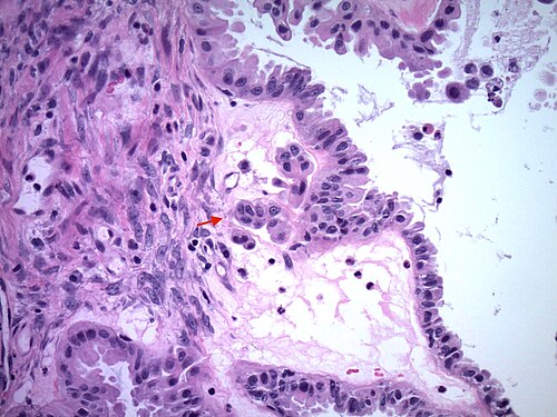 Microinvasion in a borderline serous tumor of the ovary.jpg