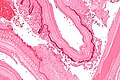Laminated liver cyst wall - high mag.jpg
