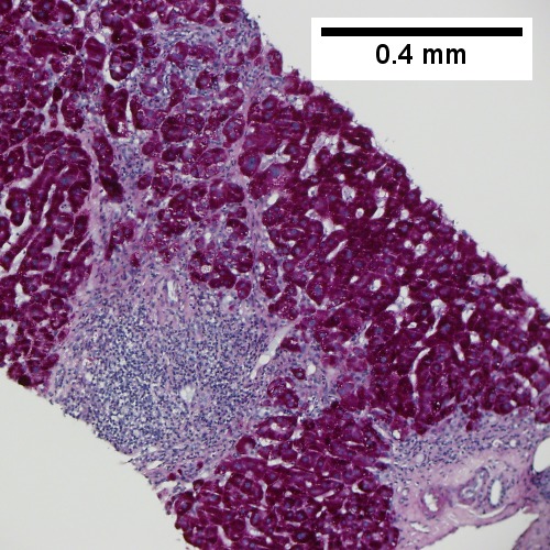PAS without diastase with extensive piecemeal necrosis (100X).