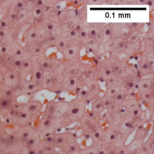 Ground glass hepatocytes (400X).