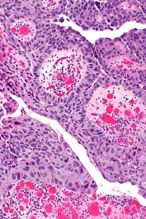 papillary urothelial cell proliferation
