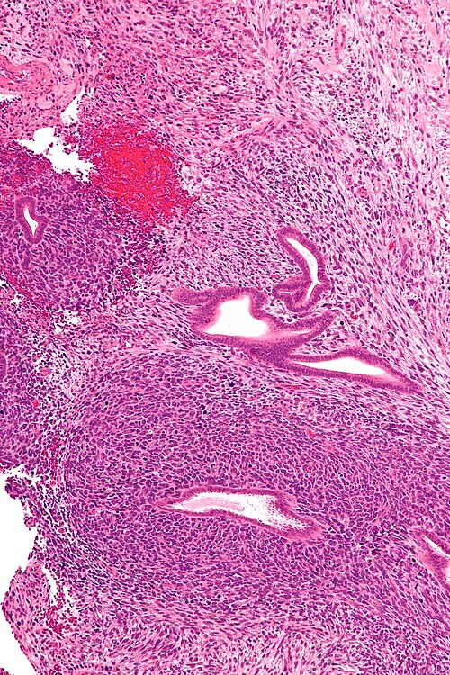 Uterine adenosarcoma - intermed mag.jpg