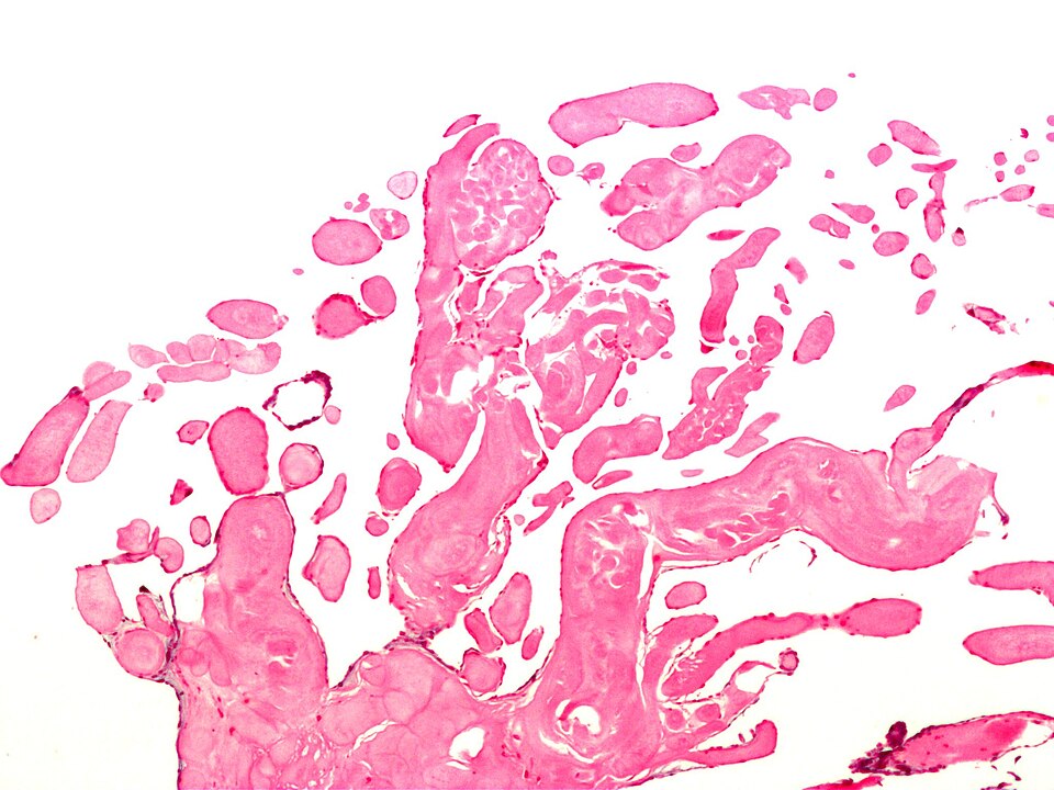 File:Papillary fibroelastoma.jpg