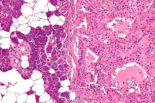 Parotid gland oncocytoma - high mag.jpg