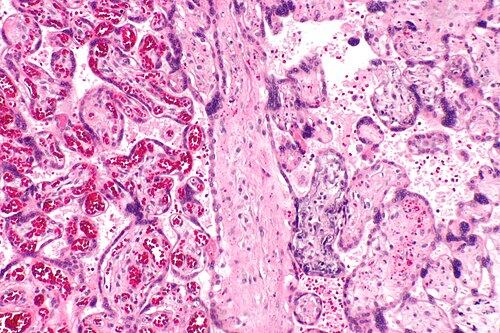 Fetal thrombotic vasculopathy -- intermed mag.jpg