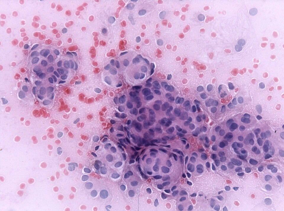File:Meningioma cytologie.jpg