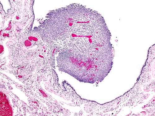 Nodular histiocytic hyperplasia in fallopian tube 2.jpg