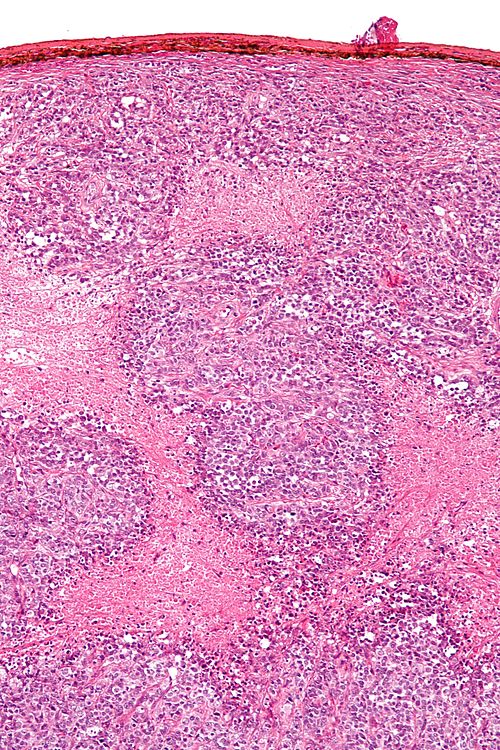 Small cell carcinoma of the ovary hypercalcemic type - intermed mag.jpg